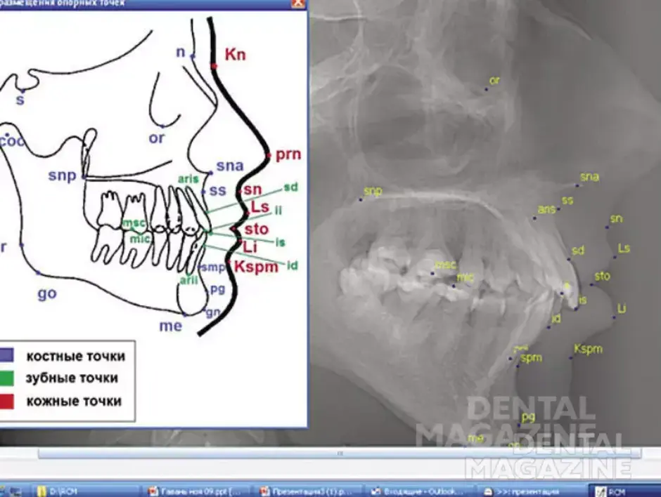 Точка 1.0 старая версия. Телерентгенограмма черепа (ТРГ). Точка sna на ТРГ. Зубные антропометрические точки черепа ТРГ.